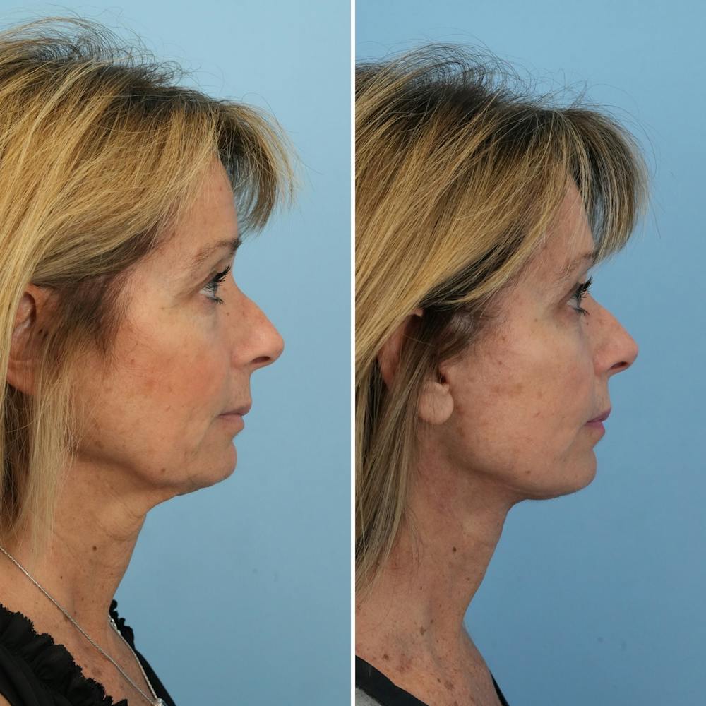 Facelift Before & After Gallery - Patient 144687167 - Image 1