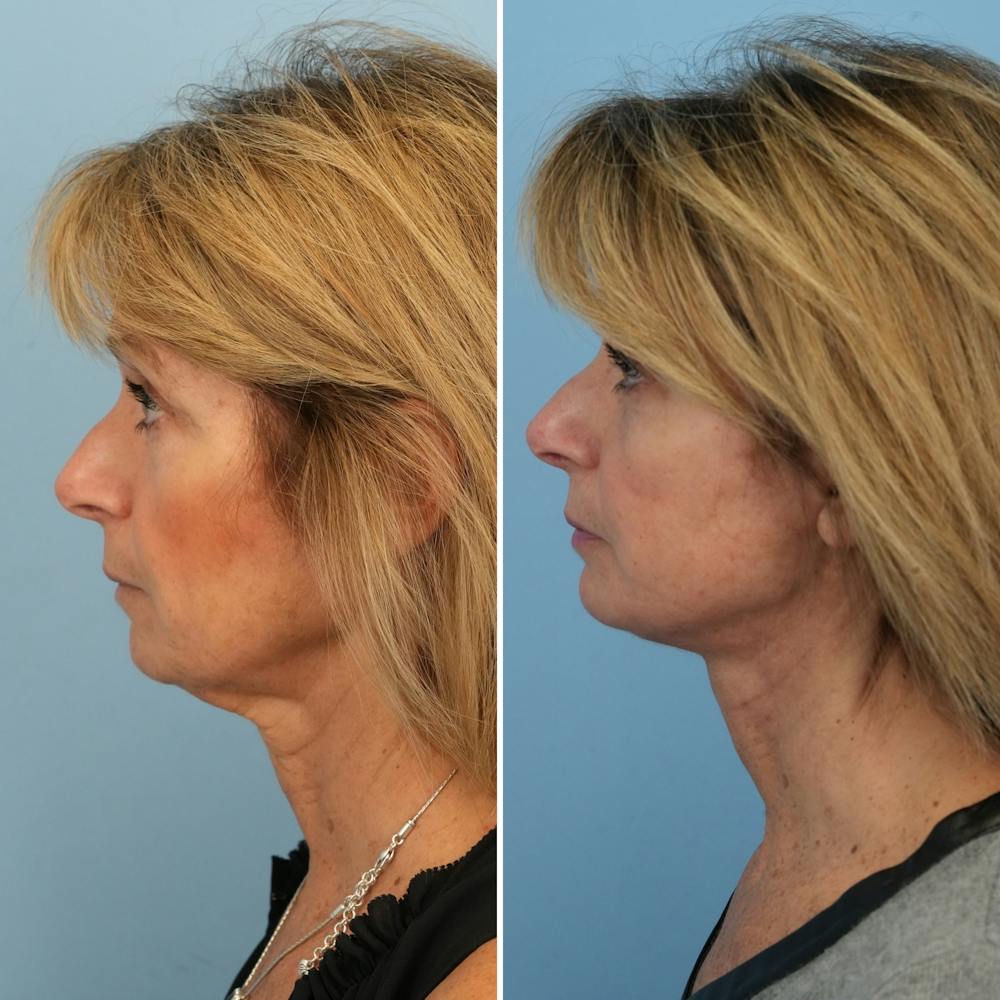 Facelift Before & After Gallery - Patient 144687167 - Image 4