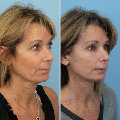 Facelift Before & After Gallery - Patient 144687167 - Image 2