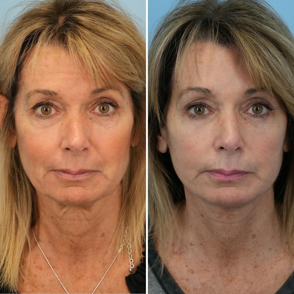 Facelift Before & After Gallery - Patient 144687167 - Image 1