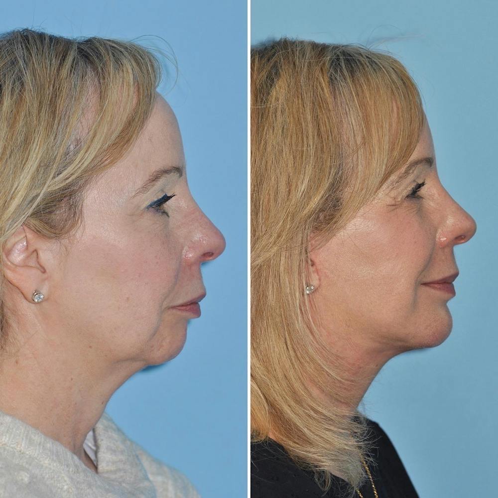 Facelift Before & After Gallery - Patient 144687168 - Image 1