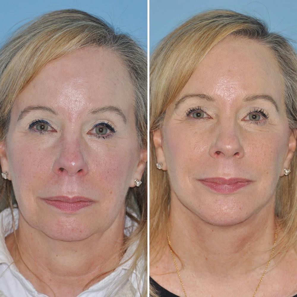 Facelift Before & After Gallery - Patient 144687168 - Image 1