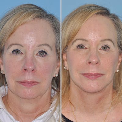 Facelift Before & After Gallery - Patient 144687168 - Image 1