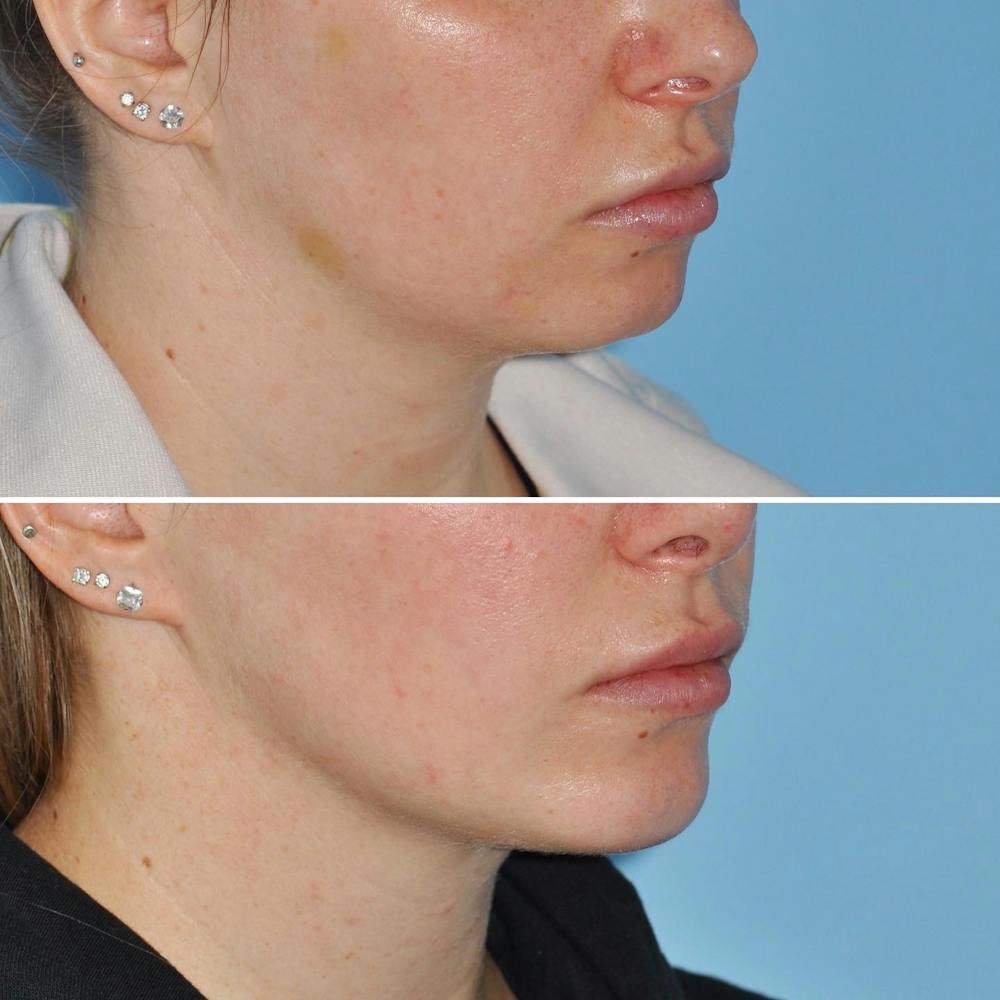 Chin Implant Before & After Gallery - Patient 144687177 - Image 1