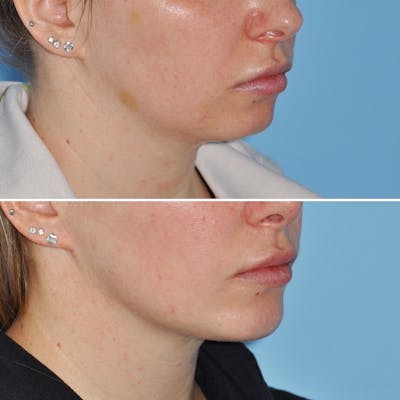 Chin Implant Before & After Gallery - Patient 144687177 - Image 1