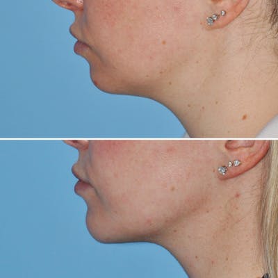 Chin Implant Before & After Gallery - Patient 144687177 - Image 2