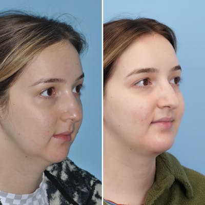 Chin Implant Before & After Gallery - Patient 144687178 - Image 2