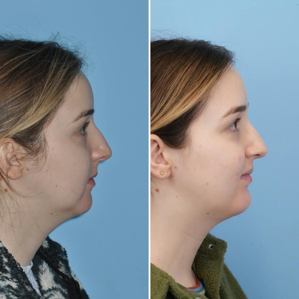Chin Implant Before & After Gallery - Patient 144687178 - Image 2