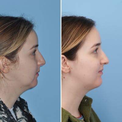 Chin Implant Before & After Gallery - Patient 144687178 - Image 2