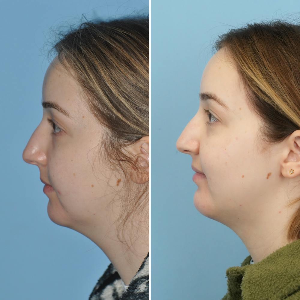 Chin Implant Before & After Gallery - Patient 144687178 - Image 4