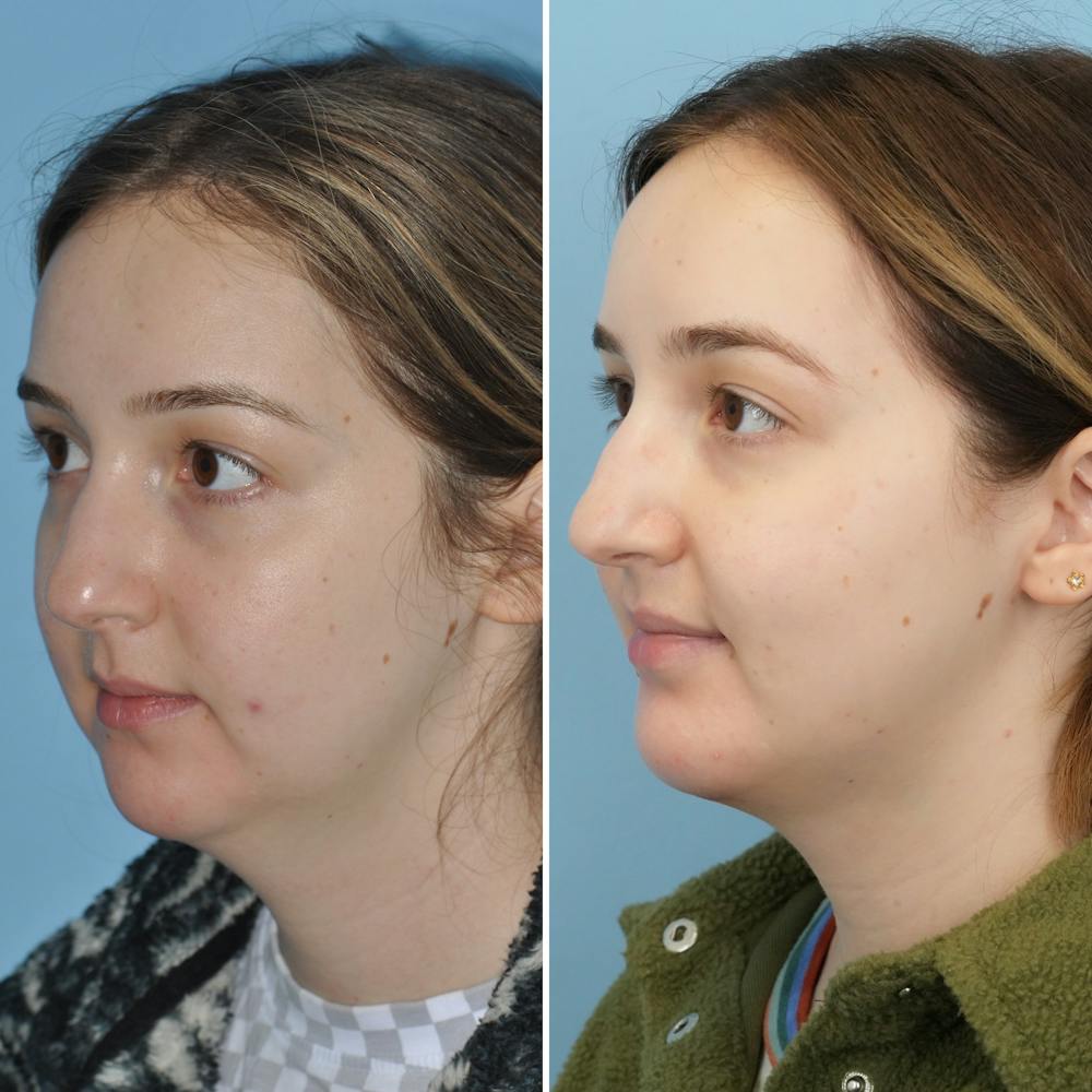 Chin Implant Before & After Gallery - Patient 144687178 - Image 5