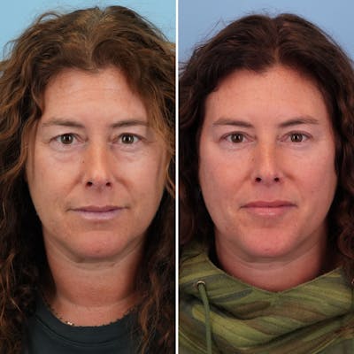 Blepharoplasty Before & After Gallery - Patient 144687194 - Image 1