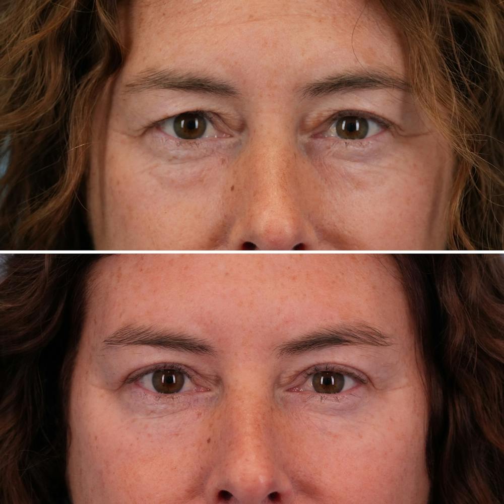 Blepharoplasty Before & After Gallery - Patient 144687194 - Image 2
