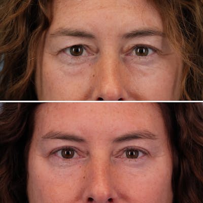 Blepharoplasty Before & After Gallery - Patient 144687194 - Image 1