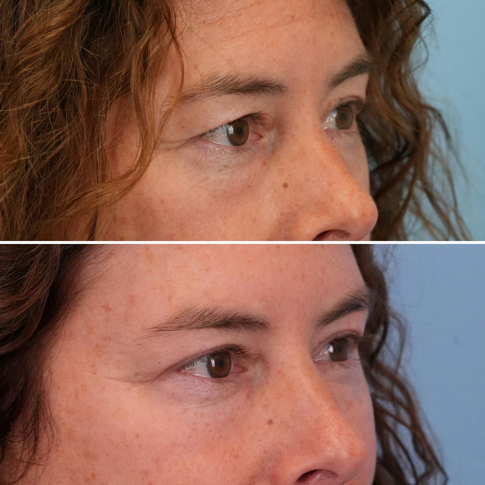 Blepharoplasty Before & After Gallery - Patient 144687194 - Image 2