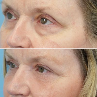 Blepharoplasty Before & After Gallery - Patient 144687195 - Image 2