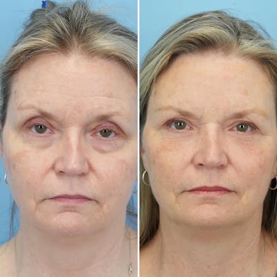 Blepharoplasty Before & After Gallery - Patient 144687195 - Image 1