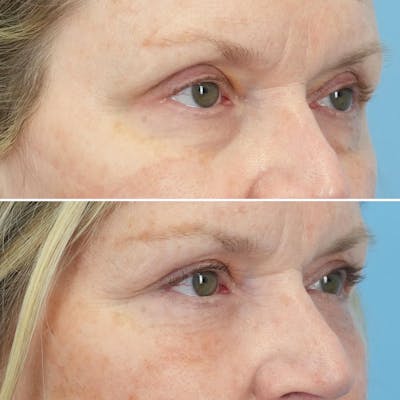 Blepharoplasty Before & After Gallery - Patient 144687195 - Image 4