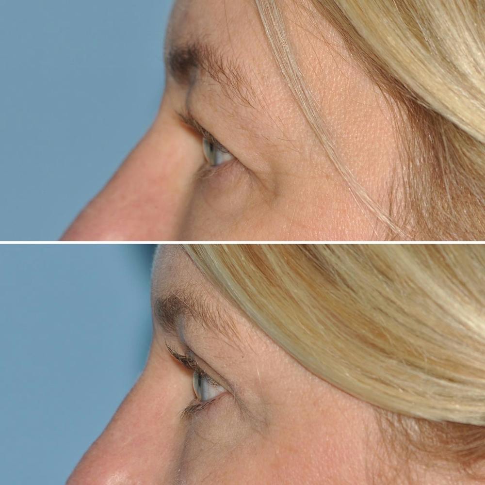 Blepharoplasty Before & After Gallery - Patient 144687196 - Image 5