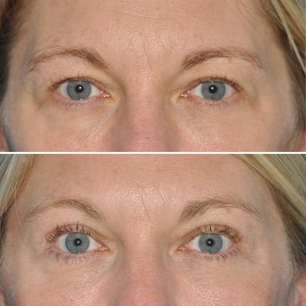 Blepharoplasty Before & After Gallery - Patient 144687196 - Image 1