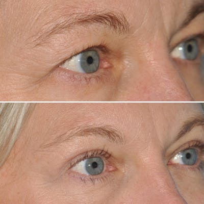 Blepharoplasty Before & After Gallery - Patient 144687196 - Image 2