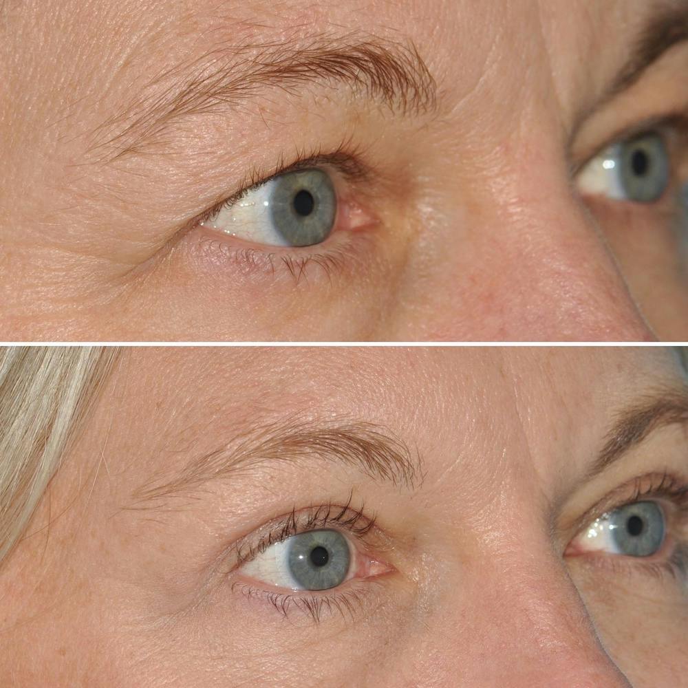 Blepharoplasty Before & After Gallery - Patient 144687196 - Image 2