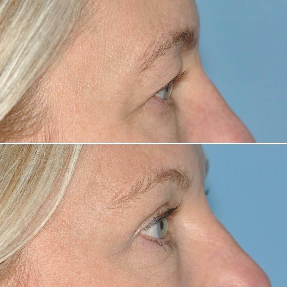 Blepharoplasty Before & After Gallery - Patient 144687196 - Image 3