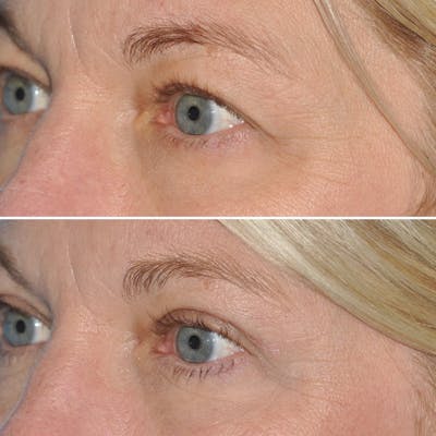 Blepharoplasty Before & After Gallery - Patient 144687196 - Image 4