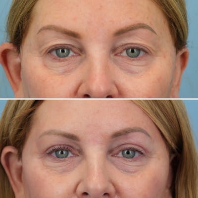 Blepharoplasty Before & After Gallery - Patient 144687202 - Image 1