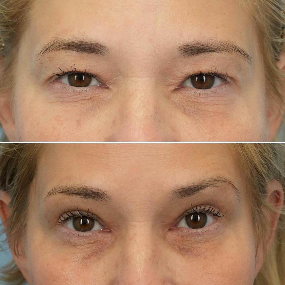 Blepharoplasty Before & After Gallery - Patient 144687203 - Image 1