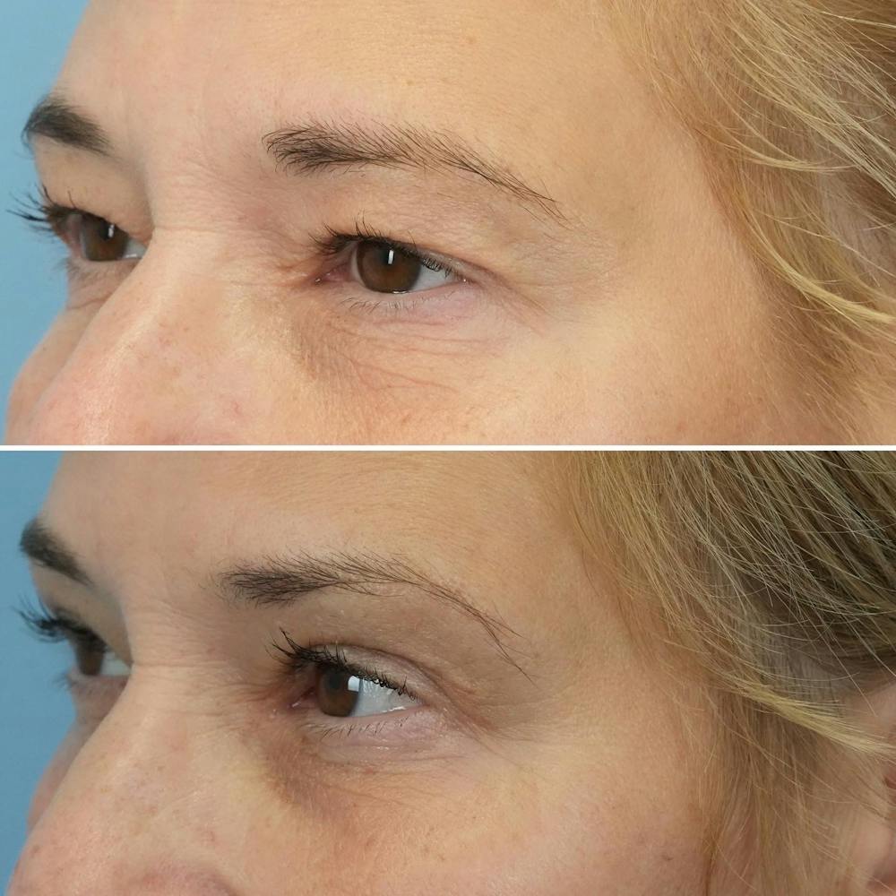 Blepharoplasty Before & After Gallery - Patient 144687203 - Image 2