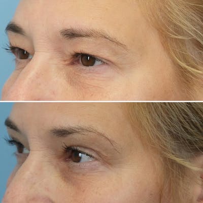 Blepharoplasty Before & After Gallery - Patient 144687203 - Image 2