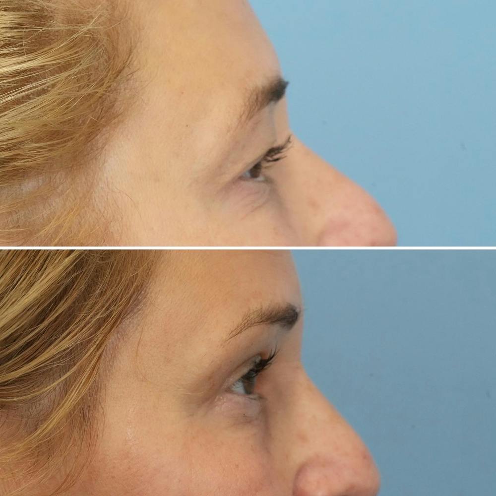 Blepharoplasty Before & After Gallery - Patient 144687203 - Image 3