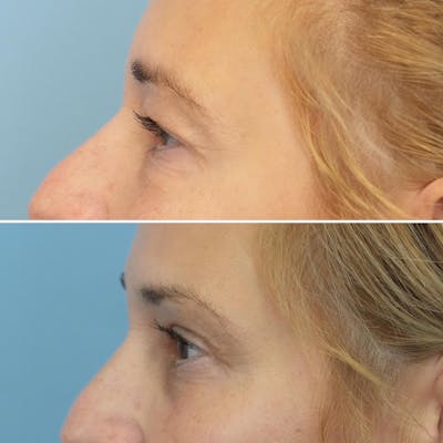 Blepharoplasty Before & After Gallery - Patient 144687203 - Image 4