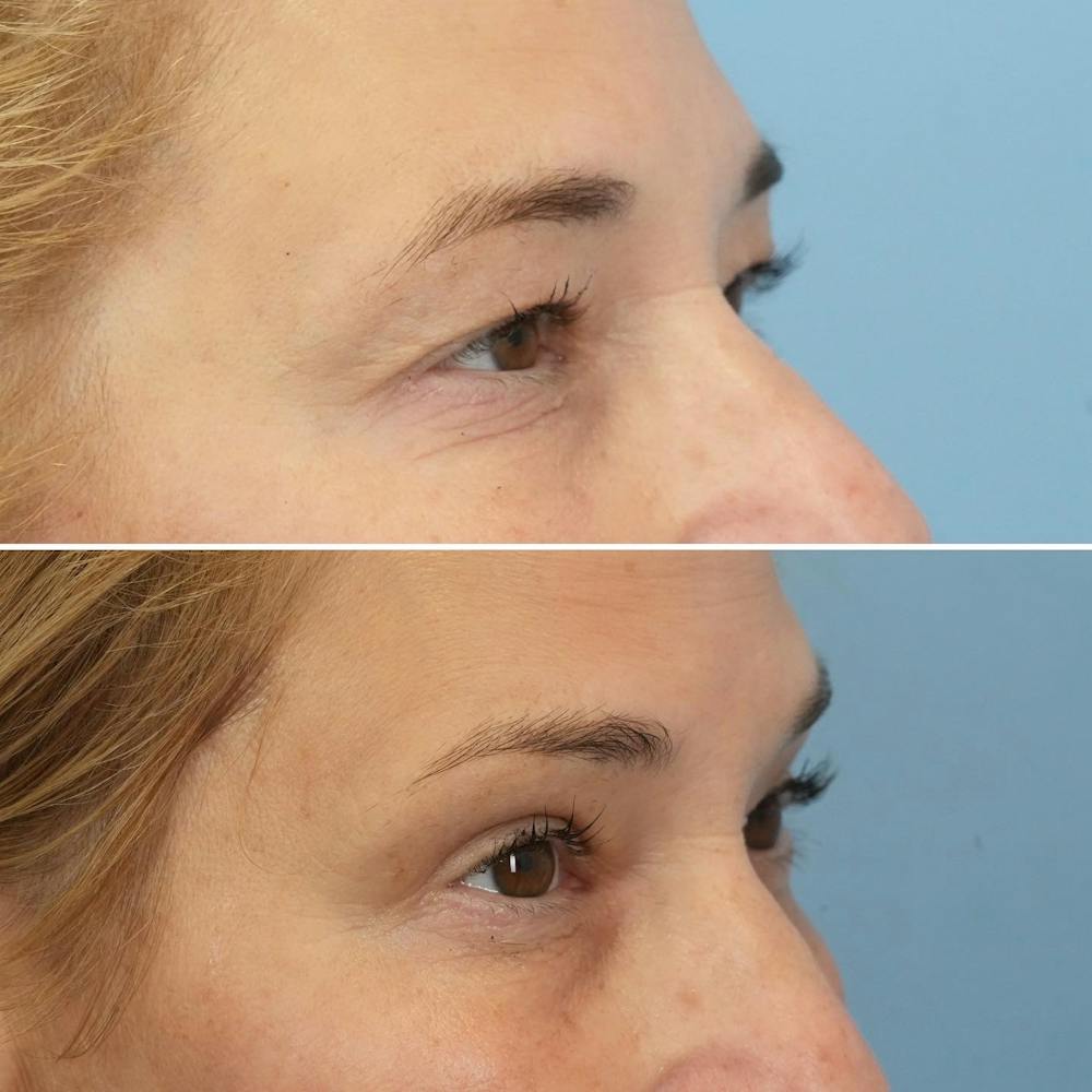 Blepharoplasty Before & After Gallery - Patient 144687203 - Image 5