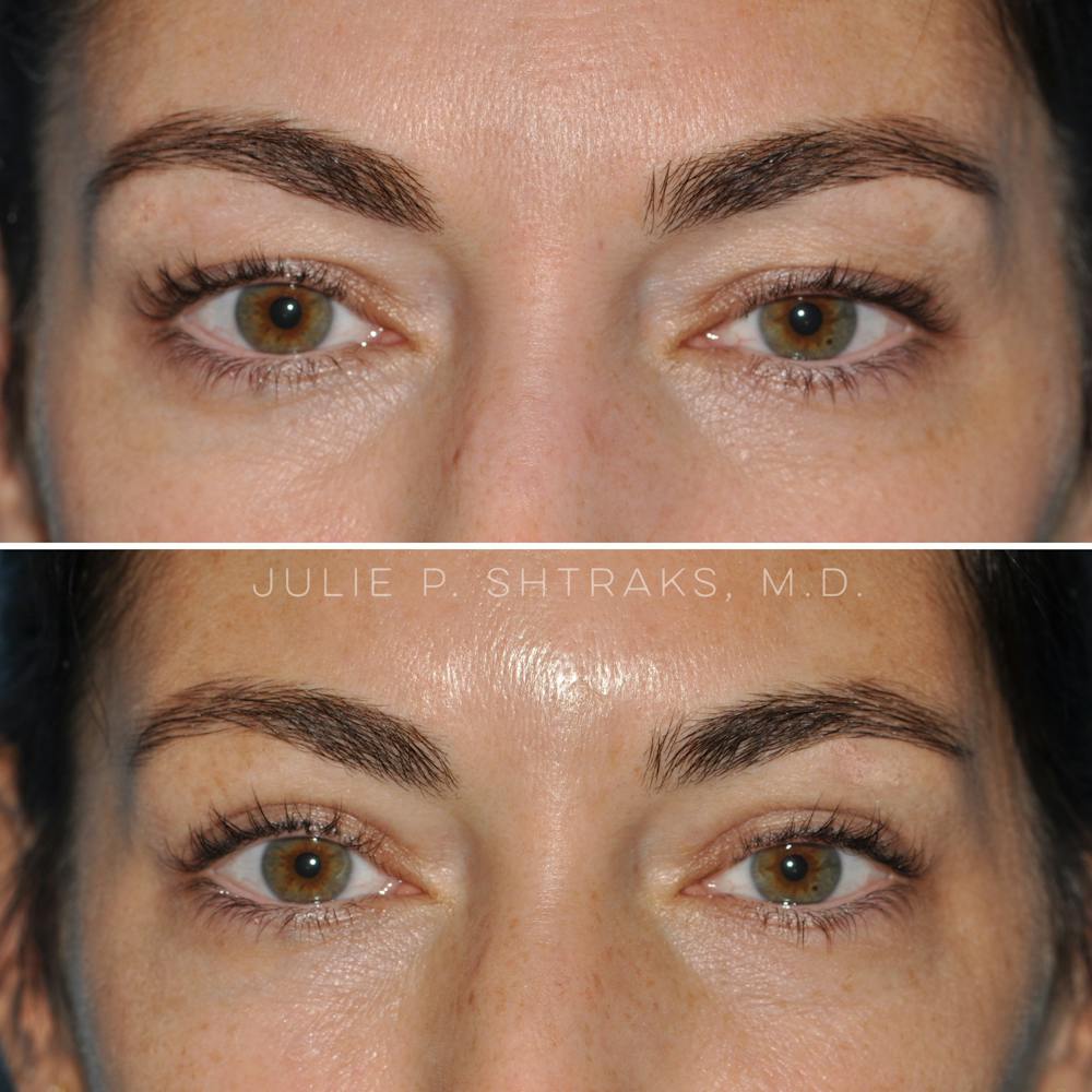Blepharoplasty Before & After Gallery - Patient 144687204 - Image 1