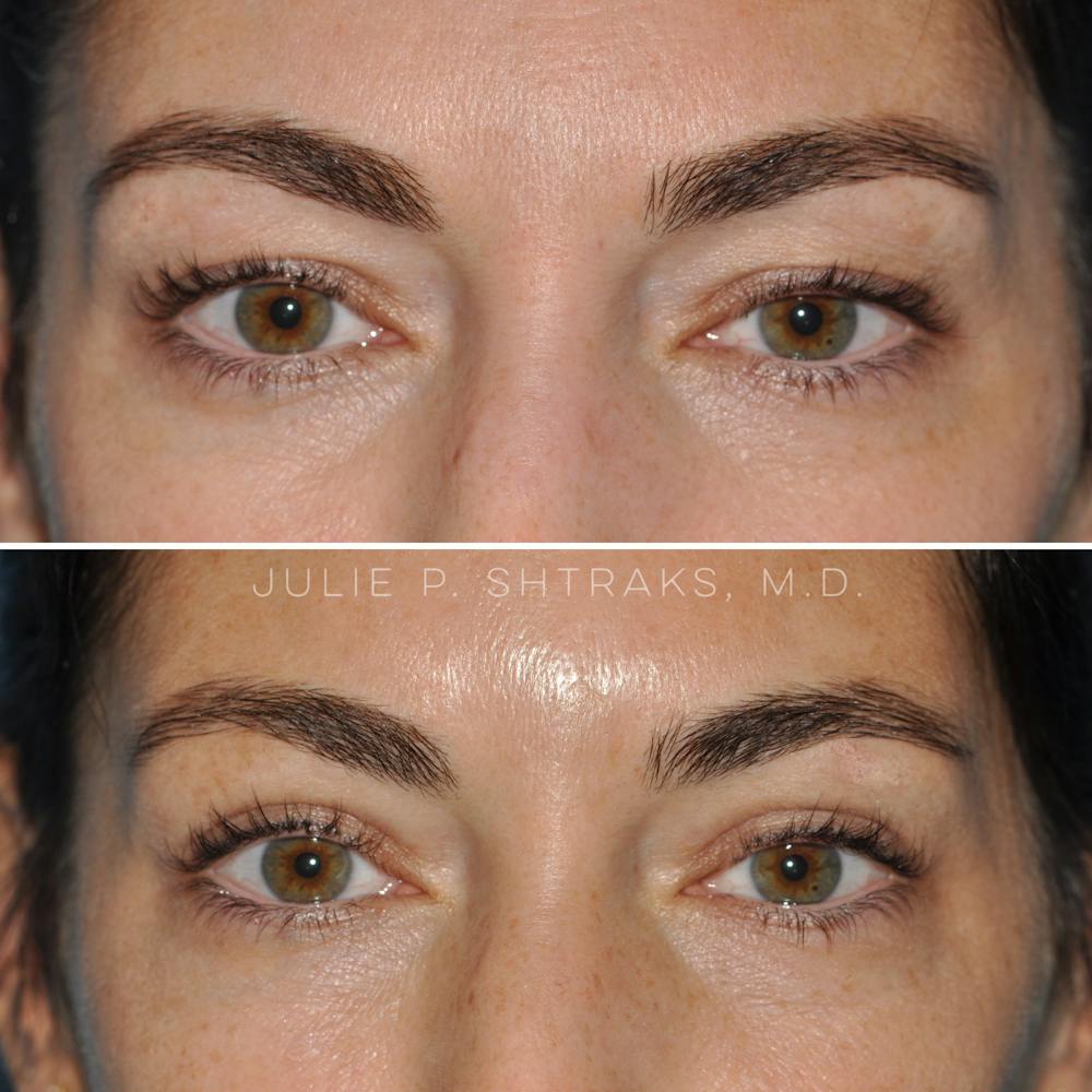 Blepharoplasty Before & After Gallery - Patient 144687204 - Image 1