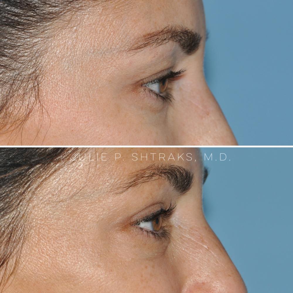 Blepharoplasty Before & After Gallery - Patient 144687204 - Image 3