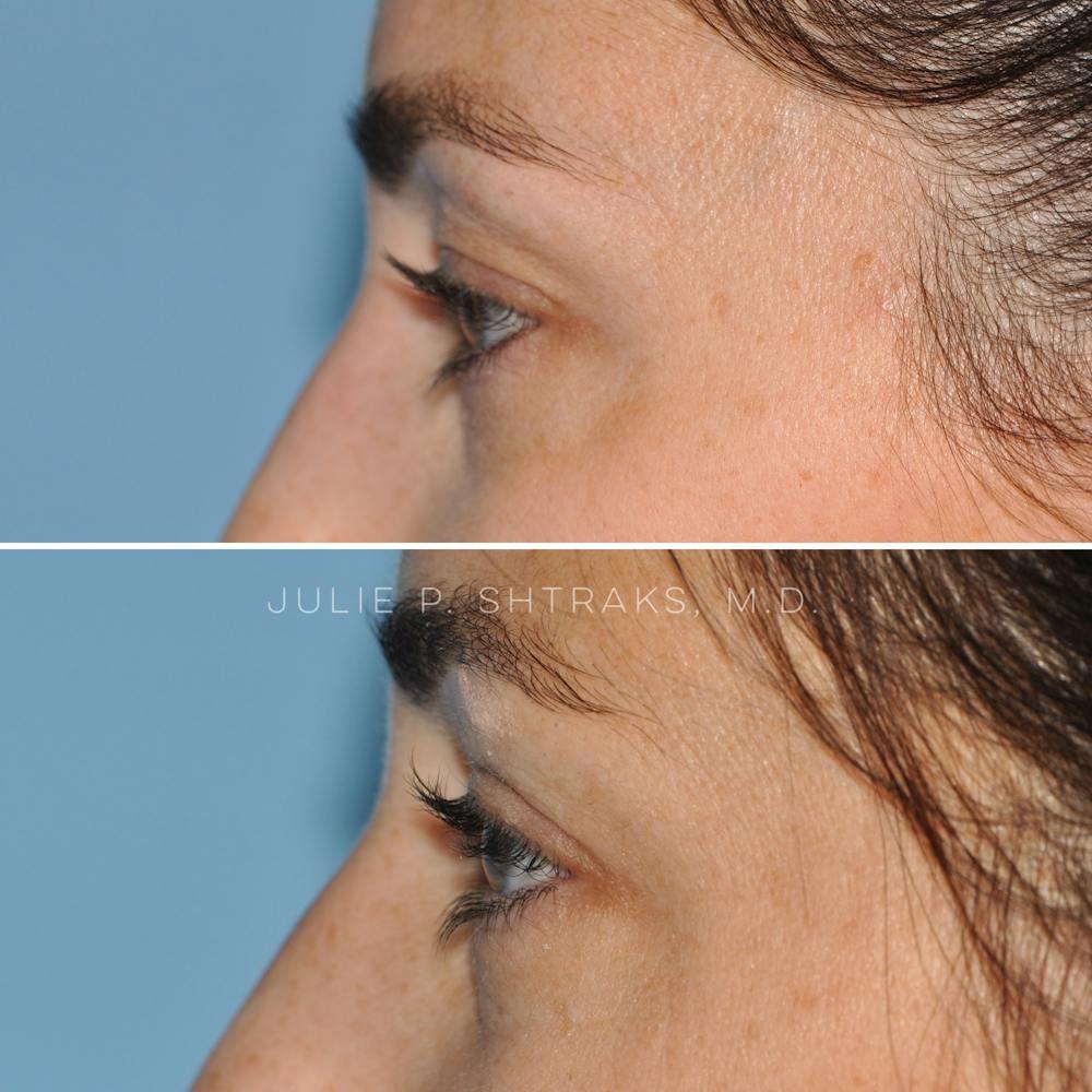 Blepharoplasty Before & After Gallery - Patient 144687204 - Image 5