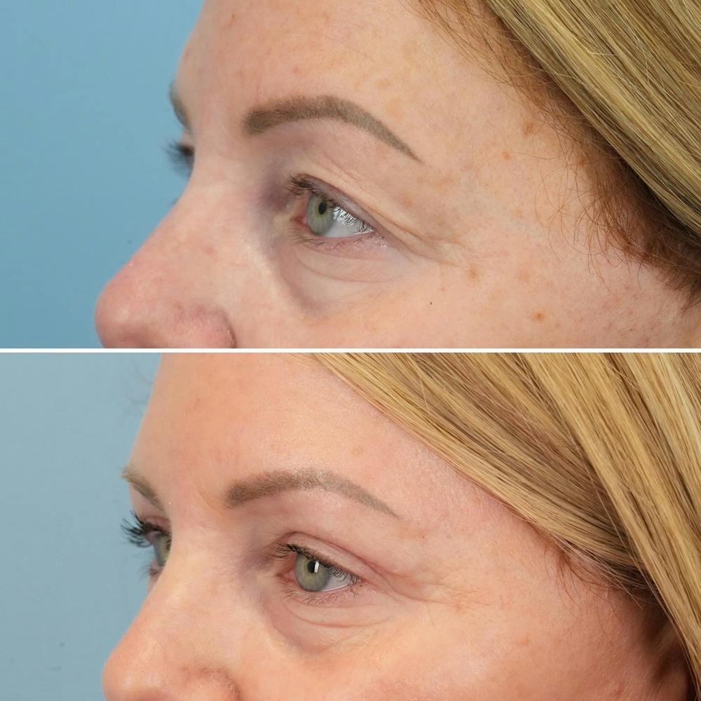 Blepharoplasty Before & After Gallery - Patient 144687213 - Image 1