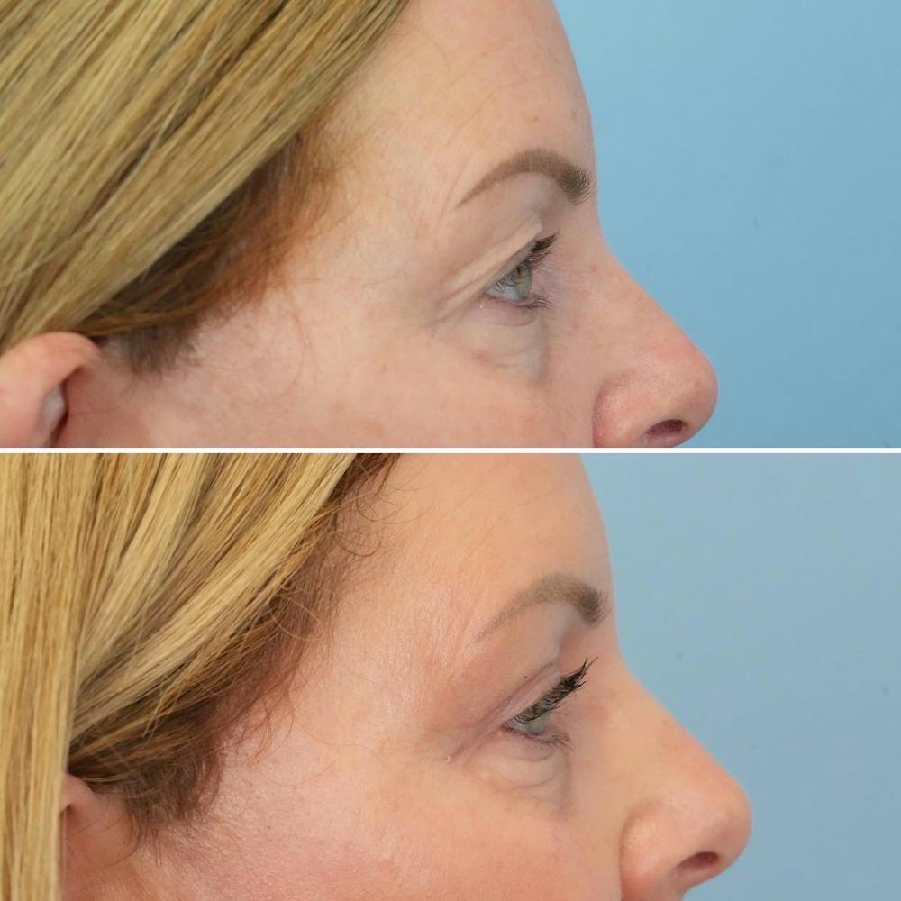 Blepharoplasty Before & After Gallery - Patient 144687213 - Image 2