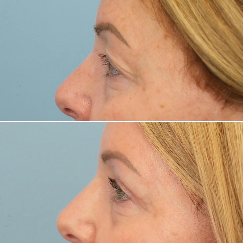 Blepharoplasty Before & After Gallery - Patient 144687213 - Image 3