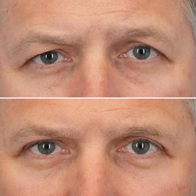 Blepharoplasty Before & After Gallery - Patient 144687217 - Image 1