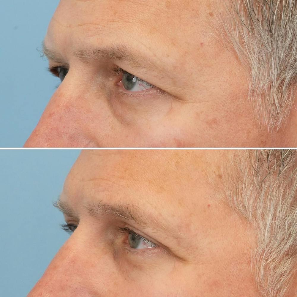 Blepharoplasty Before & After Gallery - Patient 144687217 - Image 3