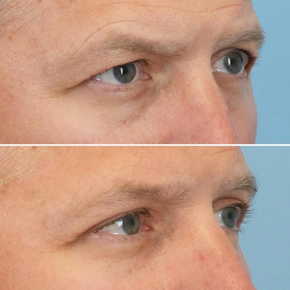 Blepharoplasty Before & After Gallery - Patient 144687217 - Image 2