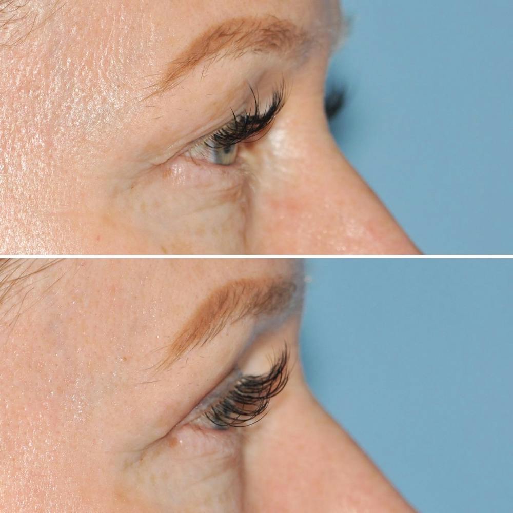 Blepharoplasty Before & After Gallery - Patient 144687218 - Image 3