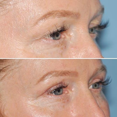 Blepharoplasty Before & After Gallery - Patient 144687218 - Image 2