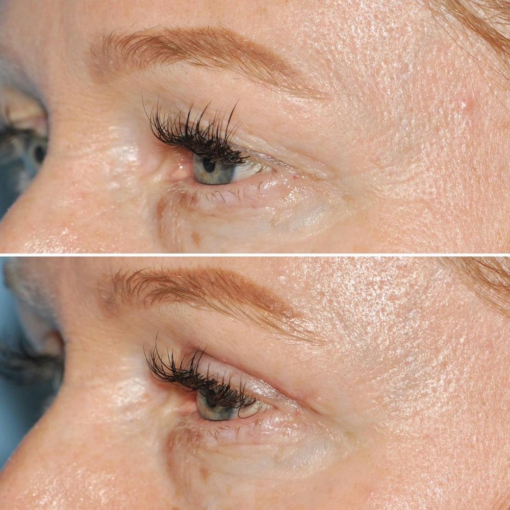 Blepharoplasty Before & After Gallery - Patient 144687218 - Image 4