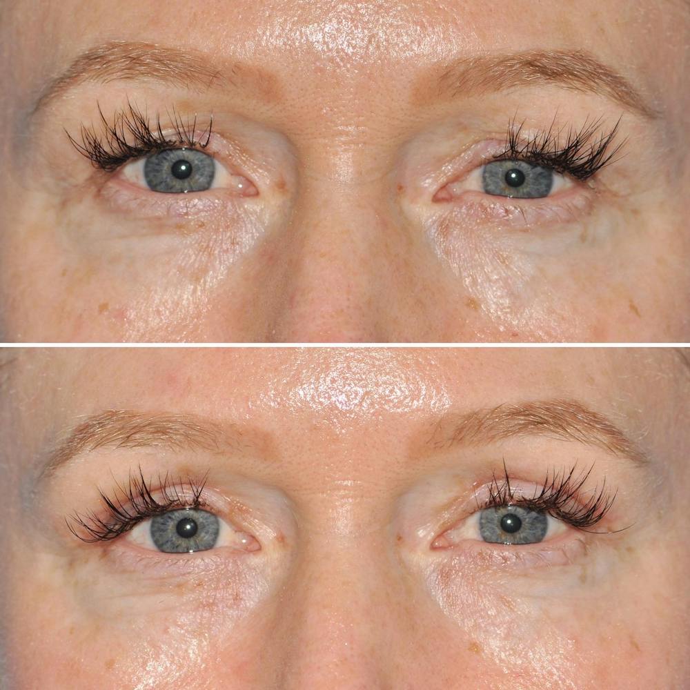 Blepharoplasty Before & After Gallery - Patient 144687218 - Image 1