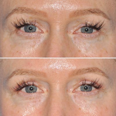 Blepharoplasty Before & After Gallery - Patient 144687218 - Image 1